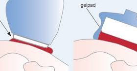 gelpad